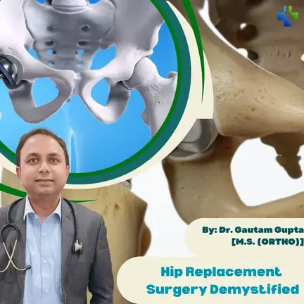 Hip Replacement Surgery Demystified