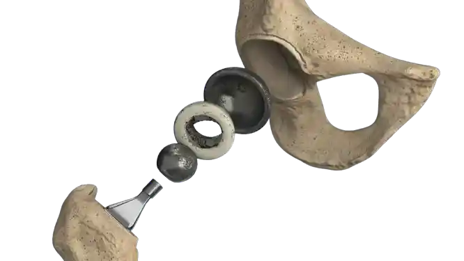 Revision Hip Replacement Surgery In Kolkata