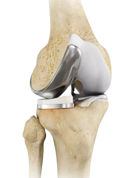 Partial Knee Replacement (PKR)