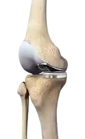 partial Knee replacement