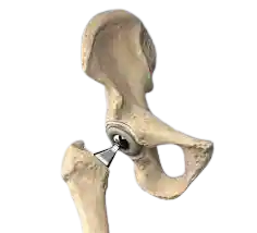 Partial Hip Replacement Hemiarthroplasty