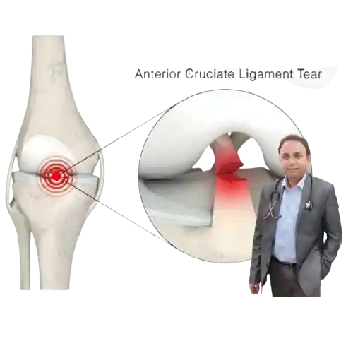 Anterior_Cruciate_Ligament_ACL_Reconstruction__5_-removebg-preview