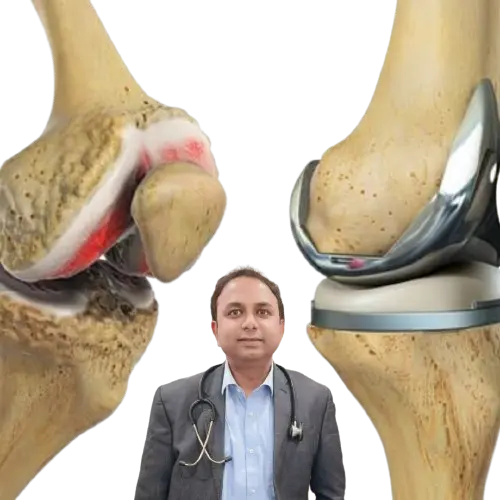 Medial Collateral Ligament (MCL) Tear & Reconstruction In Kolkata