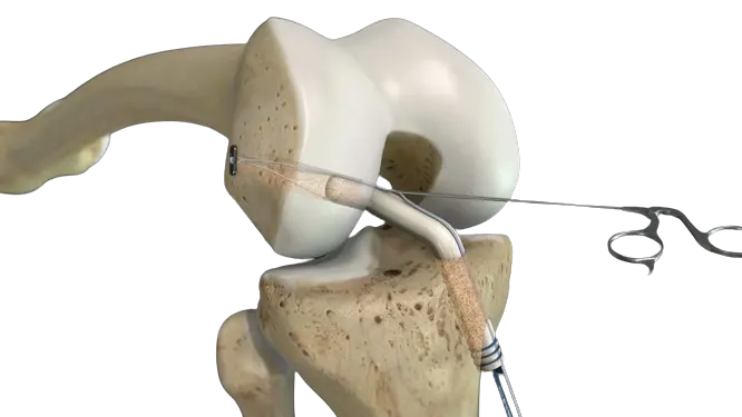 Lateral Collateral Ligament (LCL) Reconstruction